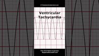 Learn ECG Rhythm Interpretation A Comprehensive Guide [upl. by Alaunnoif186]