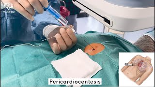 Pericardiocentesis [upl. by Thompson]