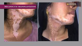 Melanocyte Transplantation  Vitiligo  Leukoderma Treatment  Dr Venkata Ramana Yamani  Contours [upl. by Cristabel]