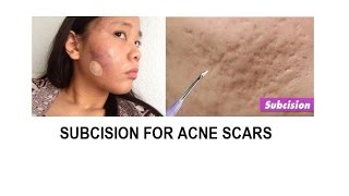 Acne scar treatment Subcision and TCA cross [upl. by Hterrag]