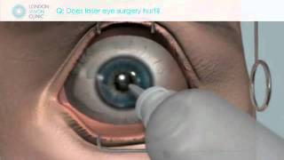 Does laser eye surgery hurt [upl. by Yma]