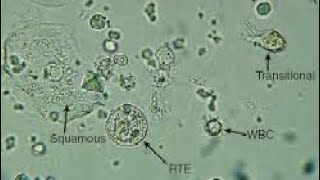 Urine Sediment Epithelial Cells [upl. by Alper641]