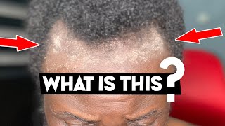 Minoxidil 2021  My Fight Against Androgenetic Alopecia Male Pattern Baldness [upl. by Kristofer]