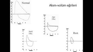 Solunum Fonksiyon Testi sonuçlarının yorumlanması dersi [upl. by Sheedy104]