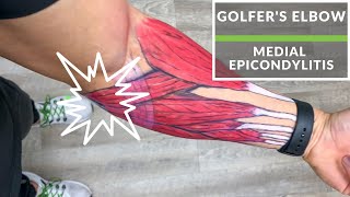 Medial Epicondylitis quotGolfers Elbowquot [upl. by Noived916]