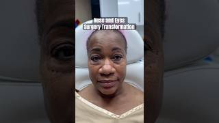 African American Nose Job and Eyelid Surgery 🤩 Beautiful Plastic Surgery Results [upl. by Michiko]