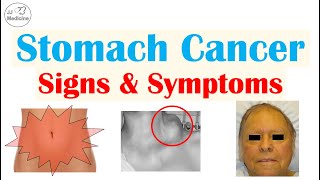 Stomach Cancer Signs and Symptoms  Clinical Manifestations of Gastric Cancer [upl. by Chic339]