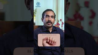 നഖത്തിൽ കാണുന്ന പാടുകൾ അപകടമാണോ  Black Lines and White Spots on Nails [upl. by Meelas]