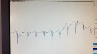 complex repetitive discharge [upl. by Crespo]