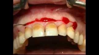 Gingival Surgery  External Bevel [upl. by Willis]