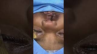 Right sided complete cleft lip repair  Cheiloplasty plastic surgery before n after results [upl. by Faux547]