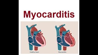 Myocarditis Causes and Treatments  2024 [upl. by Aeneus786]