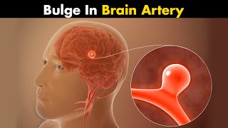 Cerebral Aneurysm  What Causes Bulge in Brain Artery UrduHindi [upl. by Htebazle]