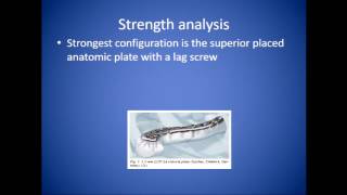 Clavicle shaft fractures  where is the pendulum now [upl. by Wettam]