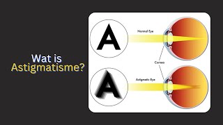 eyeoptometrist Wat is rugbybal oë of wat is Astigmatisme [upl. by Yarled]