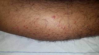 Palpable Purpura HSP  Henoch  Schonlein Purpura [upl. by Alihs635]