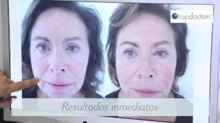 Hilos tensores para el tratamiento facial [upl. by Aiderfla]