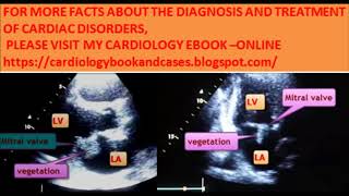 A case of endocarditis Clinical manifestations diagnosis and echocardiography [upl. by Maximilianus]