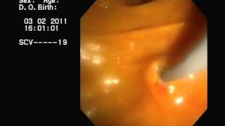 CPRE y drenaje de Colangitis Aguda ERCP acute cholangitis [upl. by Annaeed]