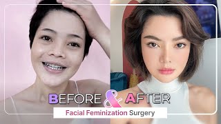 SUB Check out our Amazing Before and After FACIAL FEMINIZATION SURGERY FFS Top 5 [upl. by Arraic]