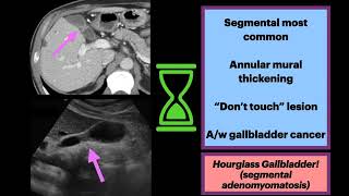 Hourglass Gallbladder Adenomyomatosis Radiology Surgery Gallbladder [upl. by Hairim]