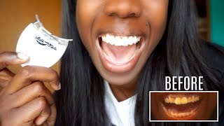 My Teeth Transformation  Dental Bridge Experience  Maintenance [upl. by Averyl451]