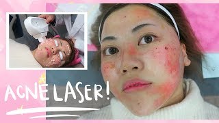 Painful ACNE LASER Experience in Korea [upl. by Mehala]