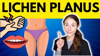 Lichen Planus WHY YOU HAVE IT amp HOW TO TREAT IT [upl. by Schug933]