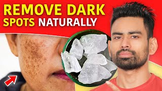 Remove Dark Spots From Face  Naturally Remove Pimple Marks Hyperpigmentation Black Spots [upl. by Nelleus]