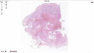 Choriocarcinoma  Histopathology [upl. by Eirellav]