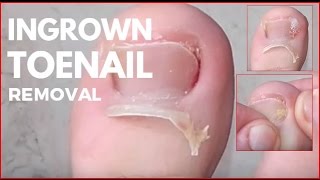 Ingrown Toenail Removal [upl. by Kristof]