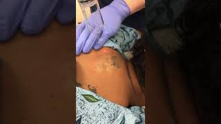 PiQo4 Advanced Laser Tattoo Removal [upl. by Illom]