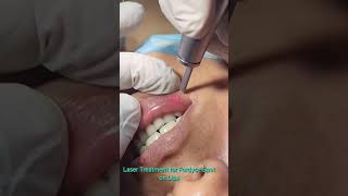 Laser treatment for Fordyce spot on lips [upl. by Nestor935]