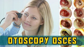 OTOSCOPY OSCEs  PLAB Image Reference [upl. by Pomfret788]