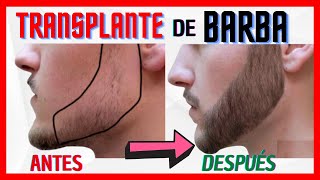 ✅ MINOXIDIL Y BARBA vs Trasplante de BARBA  🛑 ¿Cuál es el MEJOR tratamiento  Opinión Médica 👨‍⚕ [upl. by Derdle366]