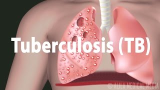 Tuberculosis TB Progression of the Disease Latent and Active Infections [upl. by Aleahc522]