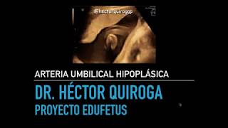 Ecografía morfológica Arteria Umbilical Hipoplásica [upl. by Rochette]