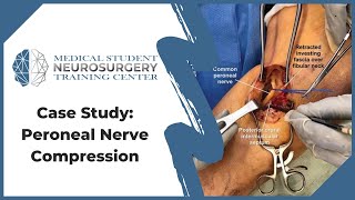 Case Study Peroneal Nerve Compression [upl. by Eronaele]