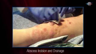 WCW Abscess Incision and Drainage [upl. by Bristow]