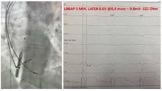 LBBAP WITH BIOTRONIK SYSTEM [upl. by Odnuges]