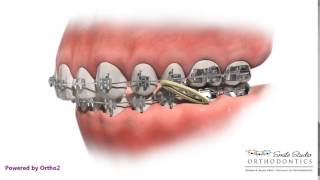 Elastics  Class II  Orthodontic Treatment [upl. by Aihsilef]