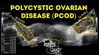 Polycystic Ovarian Disease  PCOD  Ultrasound  Case 43 [upl. by Nerral]