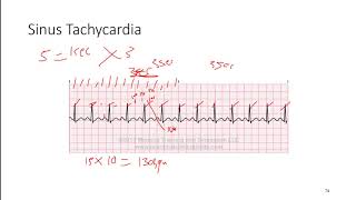 ECG 6 Sinus Rhythms and Supraventricular Tachycardia [upl. by Evilc]