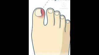 Ingrowth of nail  கால் கட்டை விரலில் பொய் ஏறினால் நீக்குவது எப்படி [upl. by Nalad]