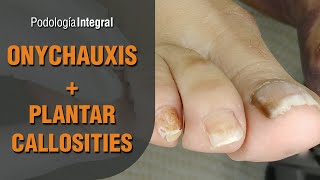 Onychauxis  Plantar callosities Podología Integral Integral Podology [upl. by Ahseele]