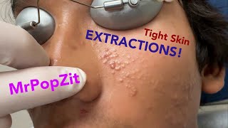 Tight skin acne extractions Comedonal acne with some inflammatory nodules Great session must see [upl. by Montagu]