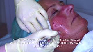 PRP Eigenbluttherapie  der bekannte VampirLifting [upl. by Enymsaj]