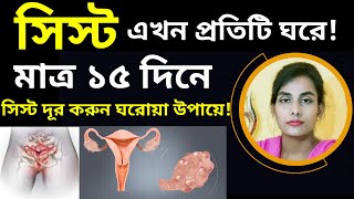 সিস্টঃ PCODPCOS থেকে মাত্র ১৫ দিনে মুক্তি পান এবং গর্ভধারণ করুন খুব সহজেই  Ovarian cyst [upl. by Decrem]