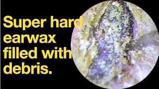 Super hard earwax filled with debris ear wax removal  ear cleaning  ASMR  relaxation  relax [upl. by Tham]