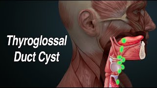 Thyroglossal Duct Cyst Midline Neck Mass [upl. by Yralam]